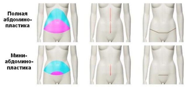 Мини и полная абдоминопластика Абдоминопластика