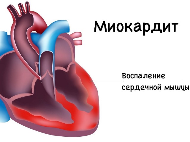 Миокардит после родов Миокардит