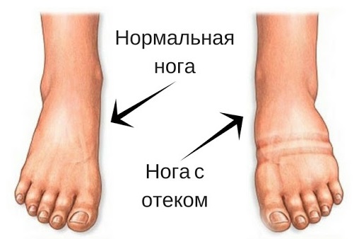 нога с отеком пример