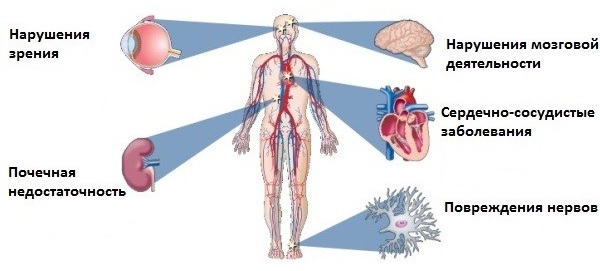 сахарный диабет с сосудистыми осложнениями