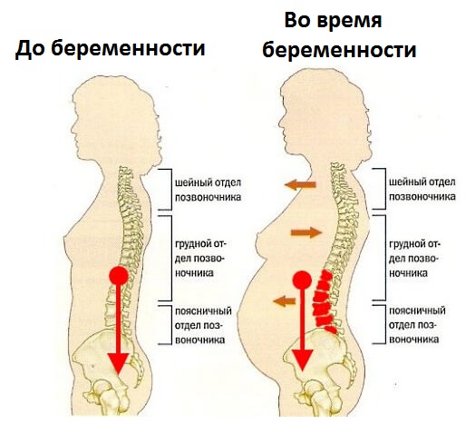 остеохондроз у беременных