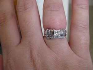 Отечная рука Как выглядит отечность на руках