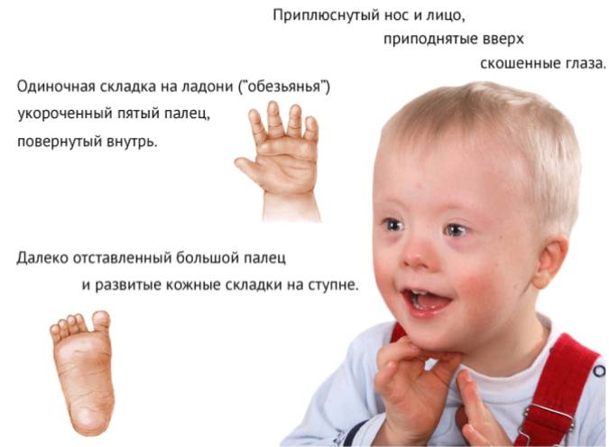 Солнечный ребенок Внешние признаки проявления синдрома Дауна