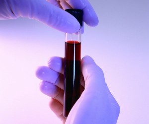 Темная моча Так ли опасна темная моча