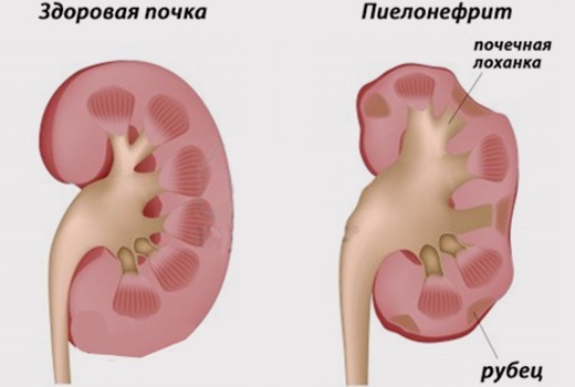 Пиелонефрит после родов Пиелонефрит