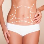 Когда можно делать пластику живота после родов Пластика живота после родов