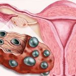 Возможность беременности при поликистозе яичников Поликистоз яичников и беременность