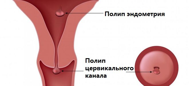 Что такое полип цервикального канала Полип цервикального канала