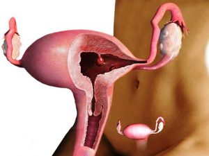 polip-endometriya-i-beremennost Полип эндометрия и беременность