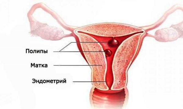 Полип эндометрия в полости матки Полип эндометрия