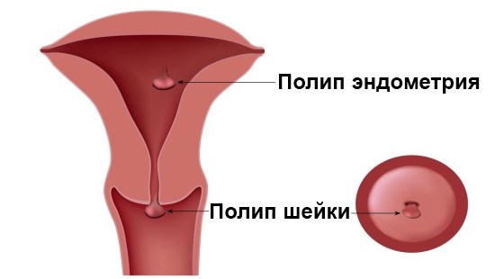 Что такое полип шейки матки Полип шейки матки