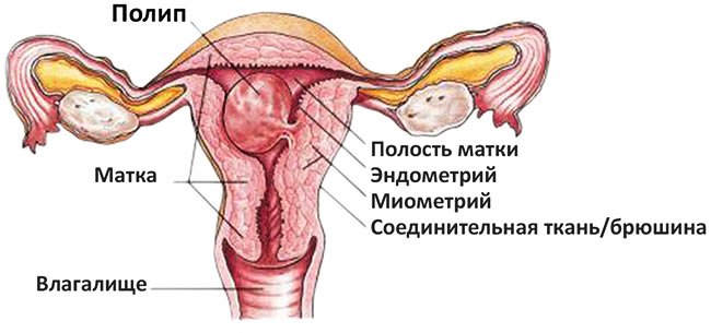 Полип в полости матки Полип в матке