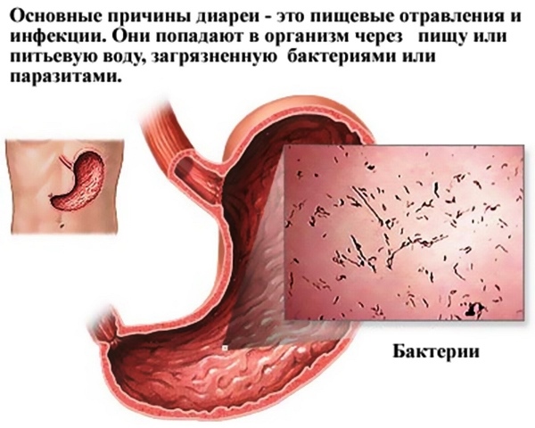 Причина поноса Причины диареи