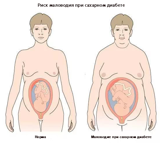маловодие при СД