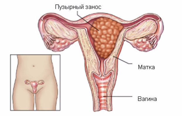 прогестерон при беременности