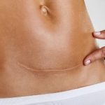 Причины расхождения шва после кесарева Расхождение шва после кесарева