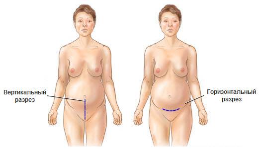 зачем бриться перед кесарево сечением