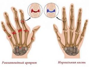 Развитие ревматоидного артрита после родов Ревматоидный артрит после родов