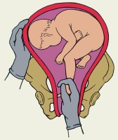 какие симптомы при резус конфликте при ранней беременности