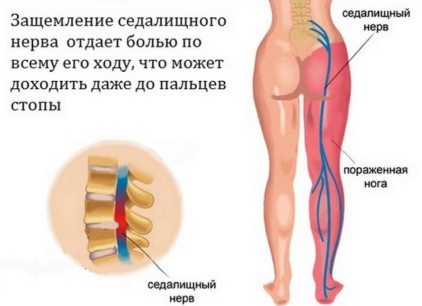 Защемление седалищного нерва Седалищный нерв
