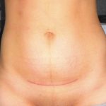 Шов после кесарева сечения Осложнения со швом после кесарева сечения