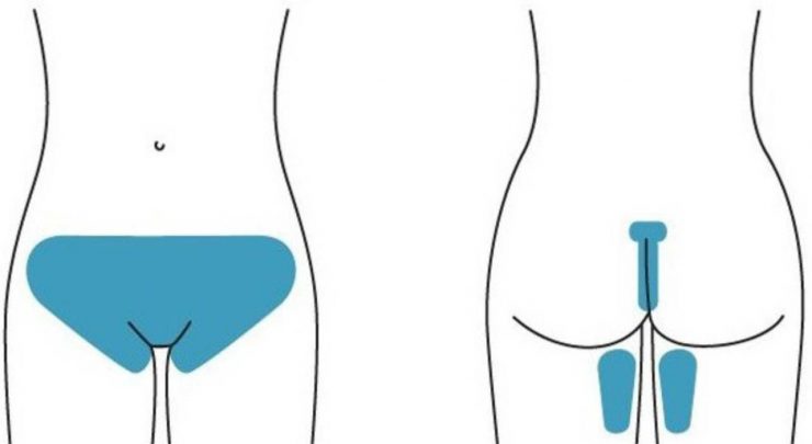 шугаринг перед родами