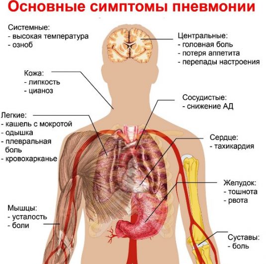 Как проявляется пневмония Симптомы пневмонии