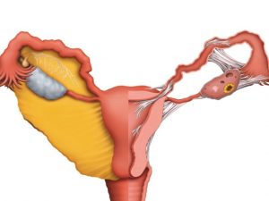 spajki-posle-kesareva-secheniya Спайки после кесарева сечения