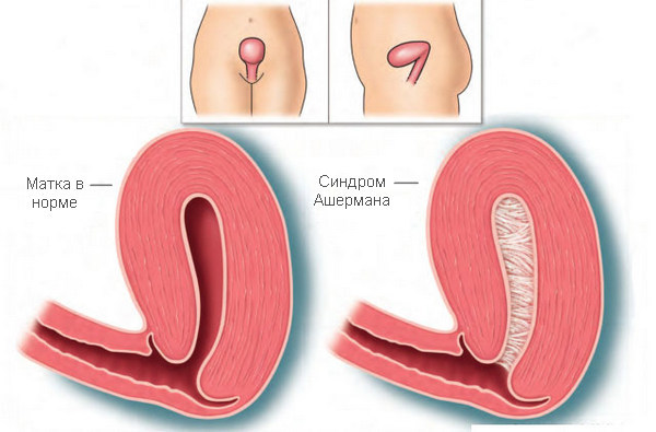 Искусственные роды