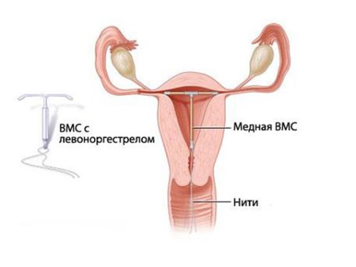 Спираль после родов Установка спирали после родов