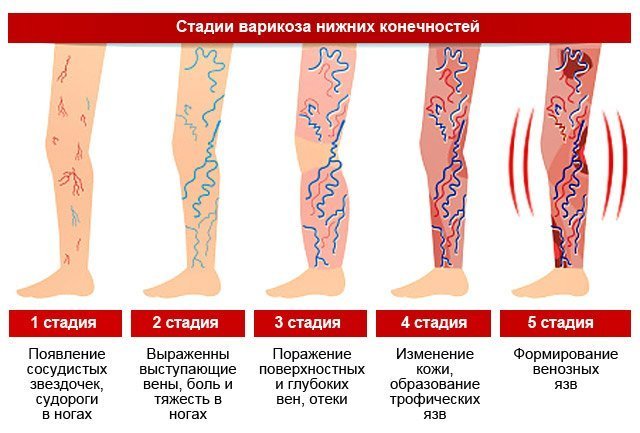 Симптомы варикоза нижних конечностей Симптомы варикоза