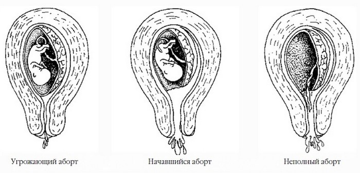признаки беременности