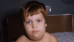 Как проявляется паротит у ребенка Свинка у мальчиков и ее последствия