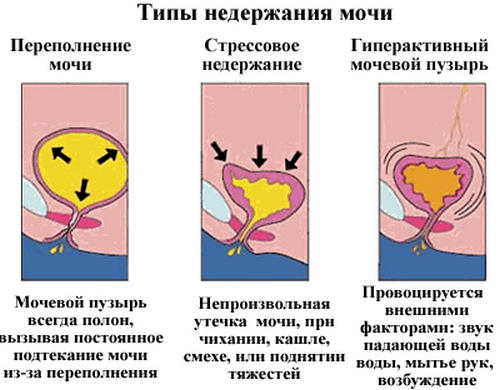 Недержание мочи Типы недержания мочи