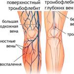 Причины тромбофлебита после родов Тромбофлебит после родов