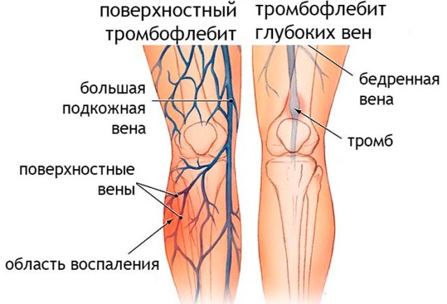 Тромбофлебит после родов Тромбофлебит после родов как причина повышения температуры