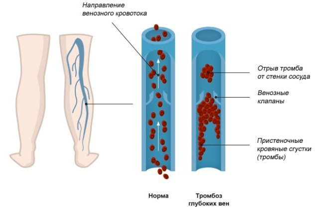 Тромбоз глубоких вен Тромбоз