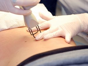 Удаление растяжек на животе после родов лазером Удаление растяжек лазером