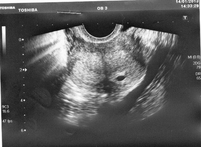 Результат УЗИ при беременности ЭКО УЗИ при беременности