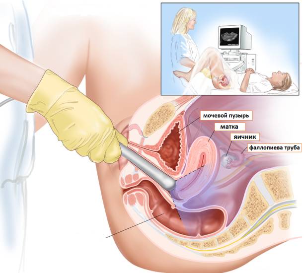 Трансвагинальное исследование женщины