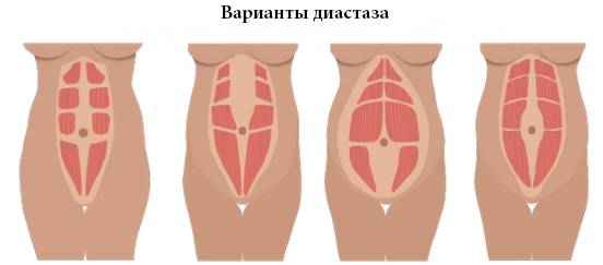 Бандаж сразу после родов