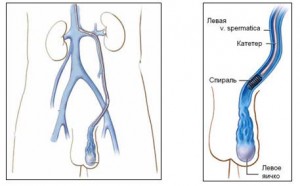 Спираль для вен в яичках Как лечат варикоцеле