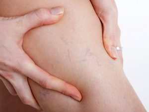 varikoz-na-nogax-posle-rodov Варикоз на ногах после родов