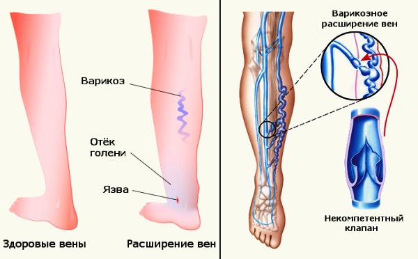Причины варикоза на ногах Варикоз на ногах