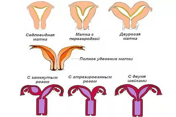 виды двурогой матки