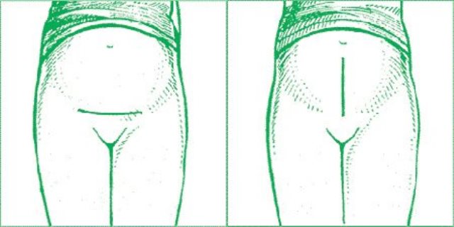 Виды шва после кесарева сечения Какие бывают швы после кесарева