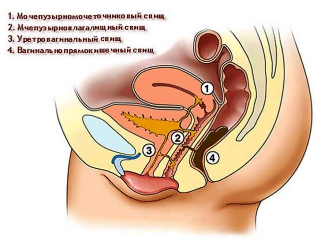 Свищи после родов Виды свищей после родов