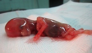 Последствия самопроизвольного аборта Как выглядит выкидыш на раннем сроке