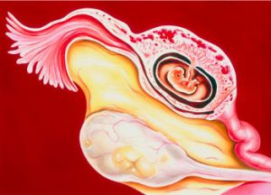 внематочная беременность после эко