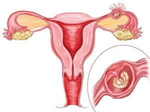 vnematochnaya-beremennost-prichiny-vozniknoveniya Причины возникновения внематочной беременности